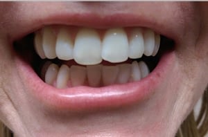 Laser Teeth Whitening - Result - Gold Package