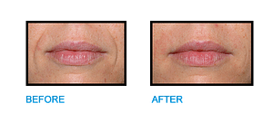 Nasolabial-Folds-Dublin-Before-and-after-photo