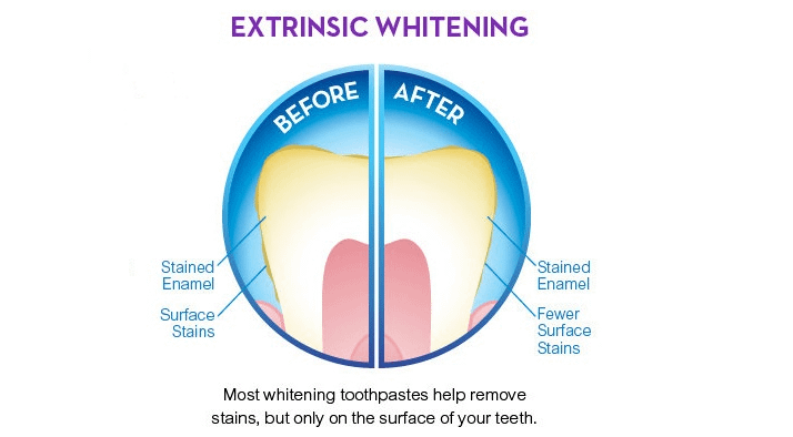Tooth Whitening Toothpaste – does it work?