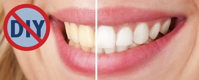 Teeth Whitening – DIY.