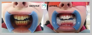teeth whitening Dublin - photo example