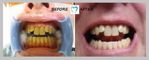 teeth whitening result 01