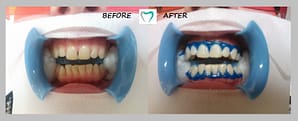 teeth whitening - result 02