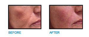 Cheek-Filler-Dublin-Before-and-After-photo