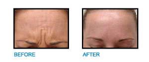 Frown-Lines-Malahide-Before-and-after-photo