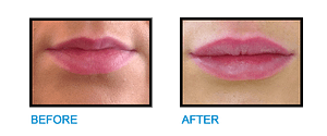 Lip-Fillers-Dublin-Before-and-After-photo