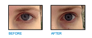 Brow-Lift-Dublin-Before-and-After-photo