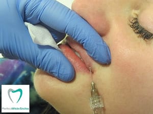 Lip Filler Dublin - treatment 3
