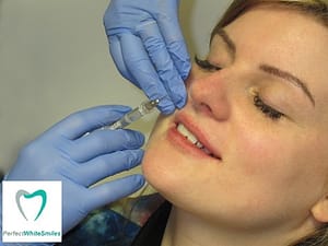 Lip Filler Dublin - treatment 1