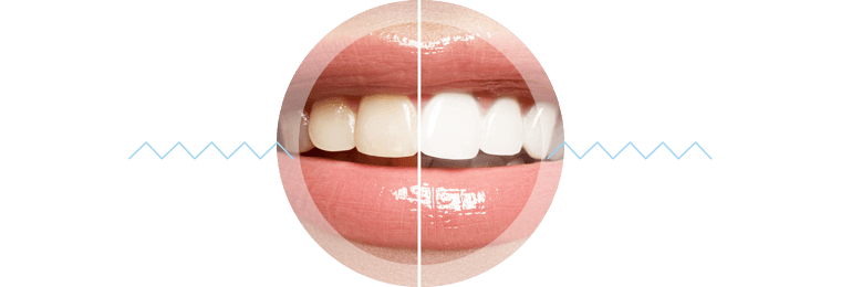 teeth-whitening-results